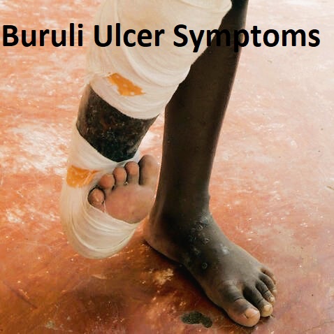Buruli Ulcer Symptoms